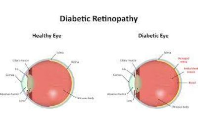 Retinopati Diabetik: Definisi, Penyebab, Gejala, Faktor Risiko, dan Pengobatan